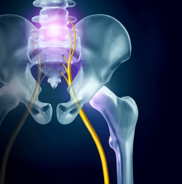 What is sciatica?