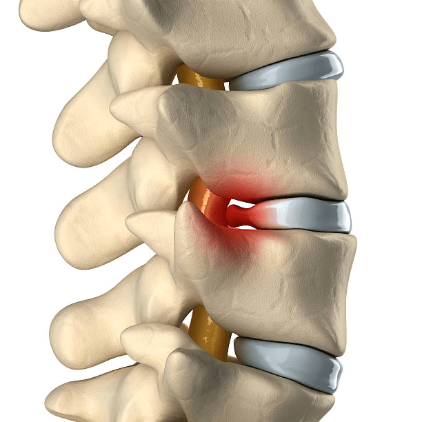 Pain relief from a lumbar disc herniation